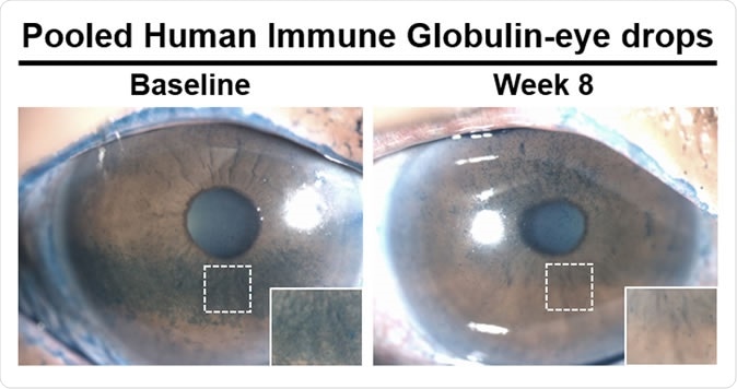 Глазные капли на основе антител показывают многообещающие результаты при лечении заболеваний сухого глаза