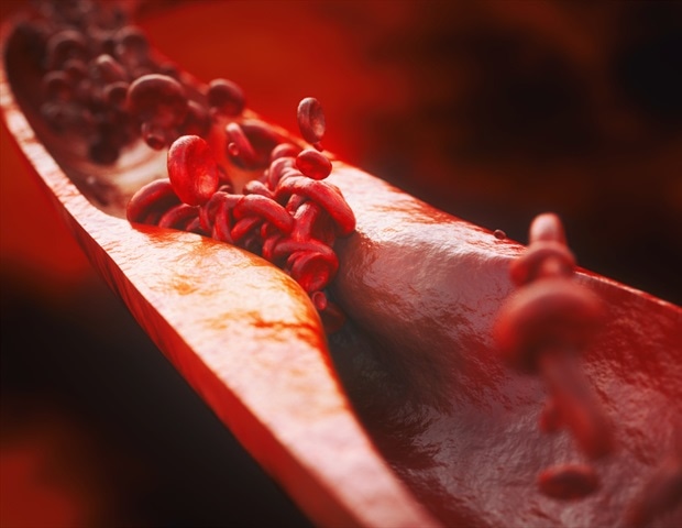 Превращение вони в терапию от атеросклероза Превращение вони в терапию от атеросклероза