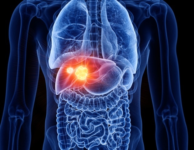 Вклад иммунной системы в гетерогенность опухоли может влиять на рост рака печени